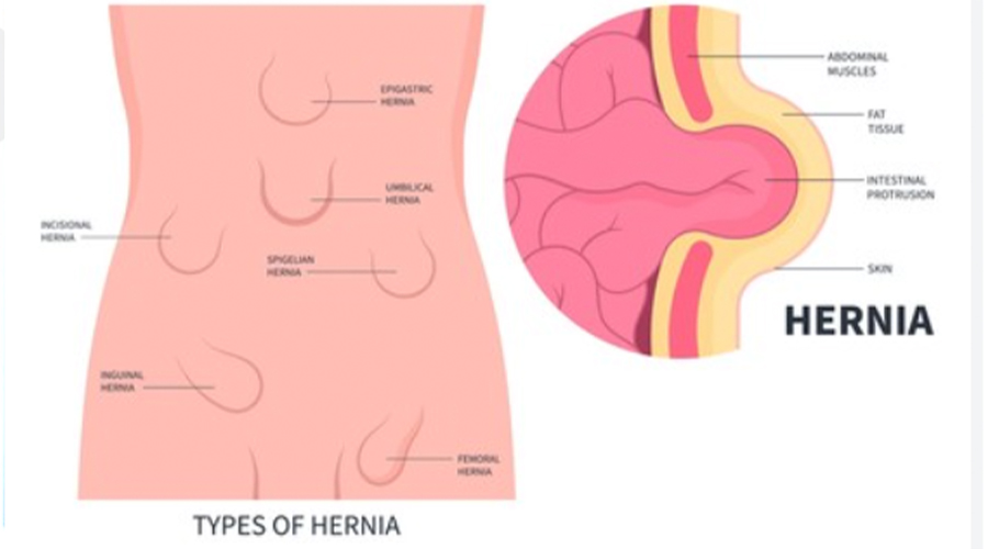 Types of hernia